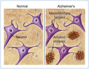 Alzheimer's Scan
